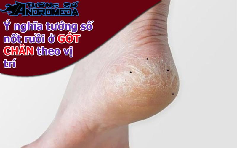 Xem nốt ruồi: Tướng nốt ruồi ở GÓT CHÂN theo vị trí