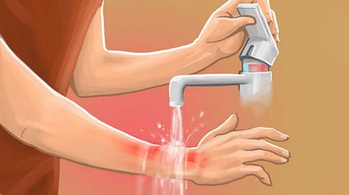 Nằm mơ thấy mình bị bỏng